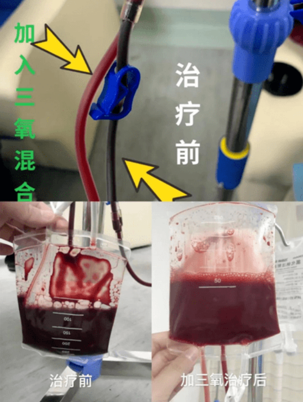 高血压、糖尿病案例分享 | 自体血免疫，防慢病，健未来！
